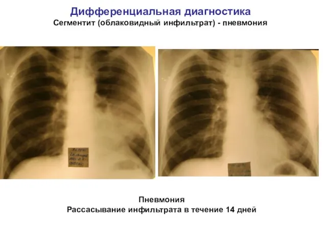 Дифференциальная диагностика Сегментит (облаковидный инфильтрат) - пневмония Пневмония Рассасывание инфильтрата в течение 14 дней