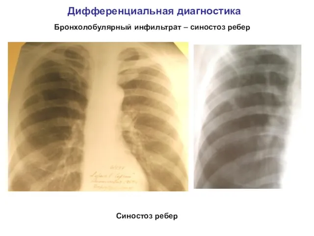 Дифференциальная диагностика Бронхолобулярный инфильтрат – синостоз ребер Синостоз ребер