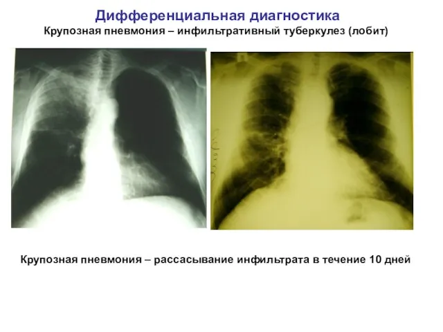 Дифференциальная диагностика Крупозная пневмония – инфильтративный туберкулез (лобит) Крупозная пневмония –