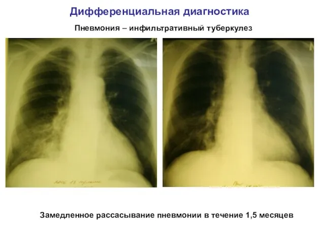 Дифференциальная диагностика Пневмония – инфильтративный туберкулез Замедленное рассасывание пневмонии в течение 1,5 месяцев