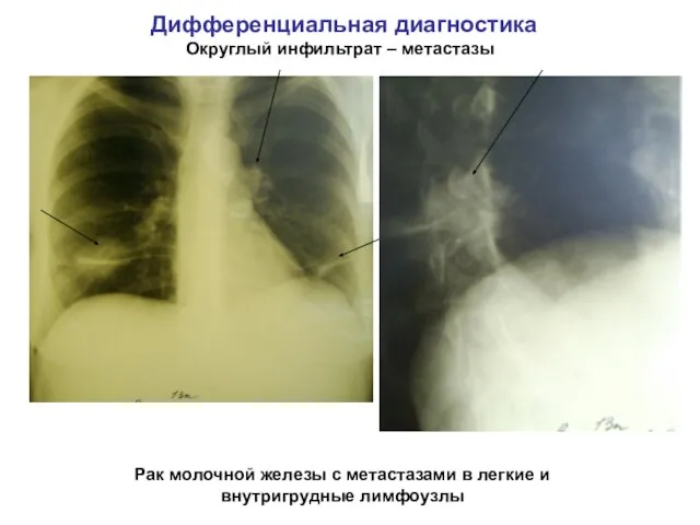 Дифференциальная диагностика Округлый инфильтрат – метастазы Рак молочной железы с метастазами в легкие и внутригрудные лимфоузлы