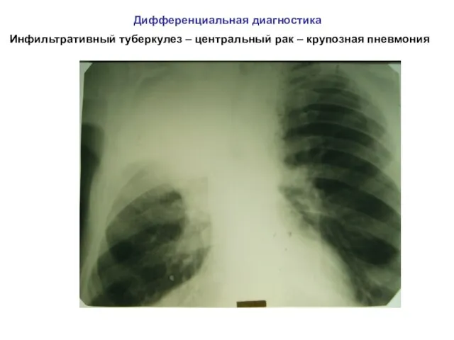 Дифференциальная диагностика Инфильтративный туберкулез – центральный рак – крупозная пневмония