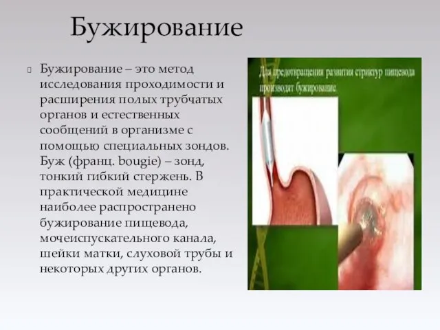 Бужирование – это метод исследования проходимости и расширения полых трубчатых органов