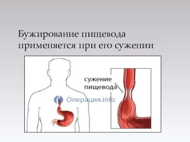 Бужирование пищевода применяется при его сужении