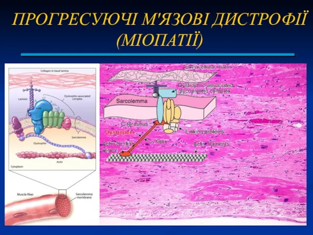 ПРОГРЕСУЮЧІ М'ЯЗОВІ ДИСТРОФІЇ (МІОПАТІЇ)