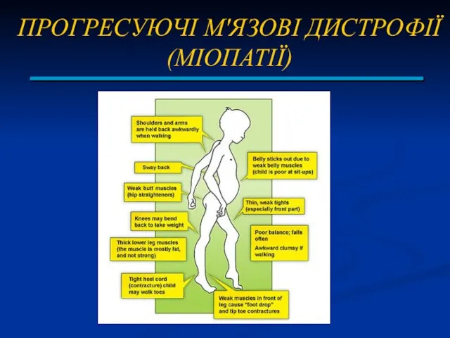 ПРОГРЕСУЮЧІ М'ЯЗОВІ ДИСТРОФІЇ (МІОПАТІЇ)