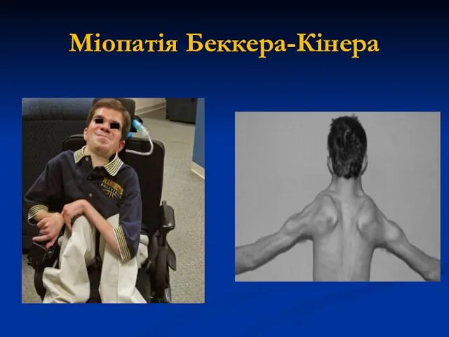 Міопатія Беккера-Кінера