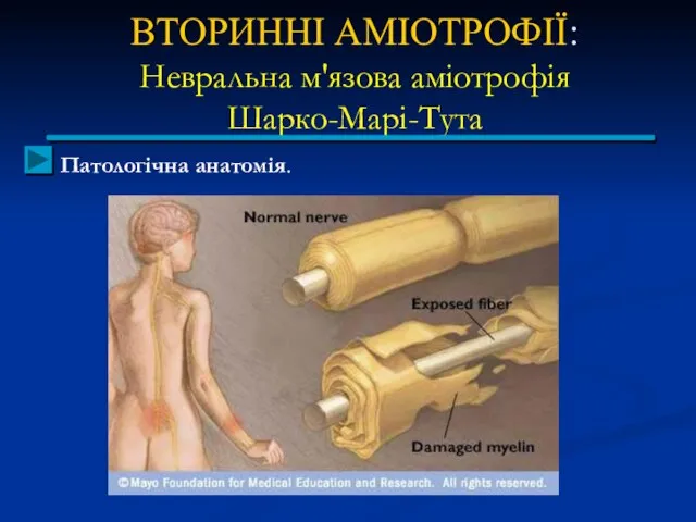 ВТОРИННІ АМІОТРОФІЇ: Невральна м'язова аміотрофія Шарко-Марі-Тута Патологічна анатомія.