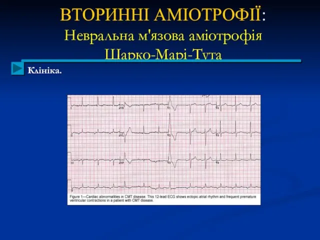 ВТОРИННІ АМІОТРОФІЇ: Невральна м'язова аміотрофія Шарко-Марі-Тута Клініка.