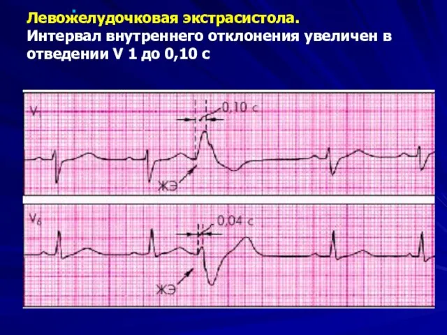 Левожелудочковая экстрасистола. Интервал внутреннего отклонения увеличен в отведении V 1 до 0,10 с