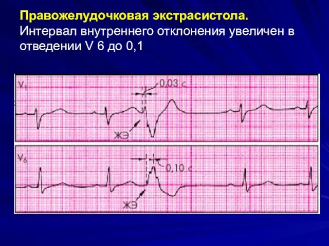 Правожелудочковая экстрасистола. Интервал внутреннего отклонения увеличен в отведении V 6 до 0,1