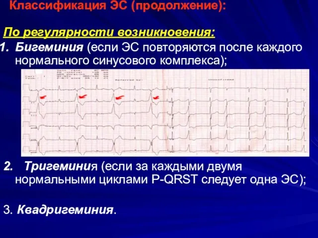 Классификация ЭС (продолжение): По регулярности возникновения: Бигеминия (если ЭС повторяются после