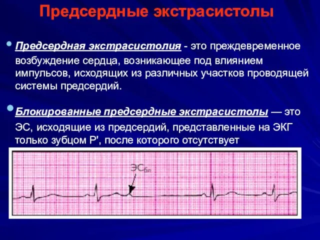 Предсердные экстрасистолы Предсердная экстрасистолия - это преждевременное возбуждение сердца, возникающее под