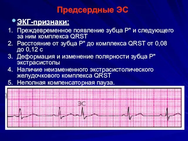 Предсердные ЭС ЭКГ-признаки: Преждевременное появление зубца Р" и следующего за ним