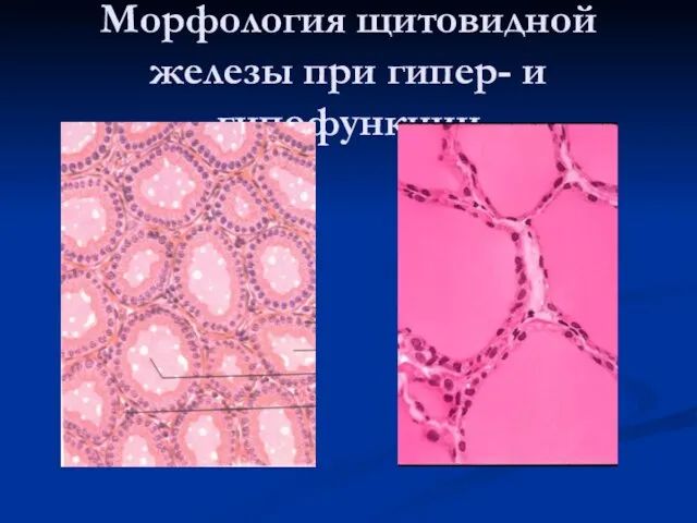 Морфология щитовидной железы при гипер- и гипофункции