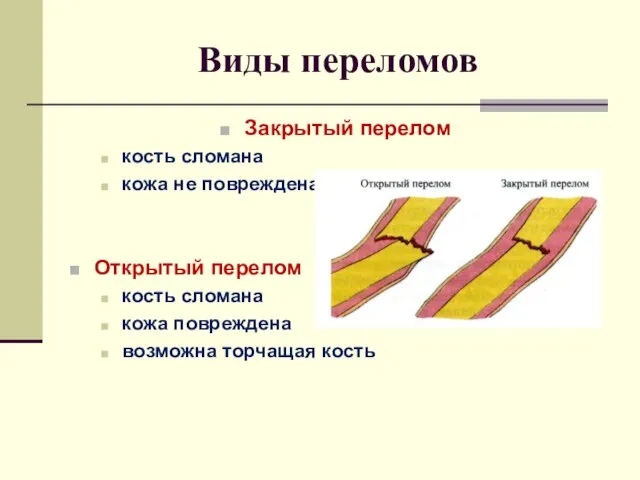 Виды переломов Закрытый перелом кость сломана кожа не повреждена Открытый перелом