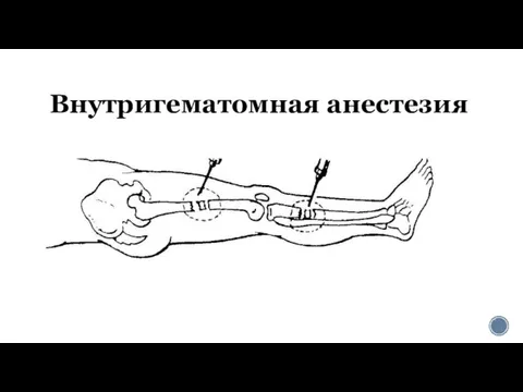 Внутригематомная анестезия