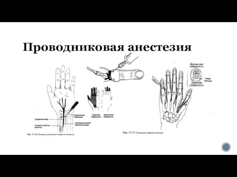 Проводниковая анестезия