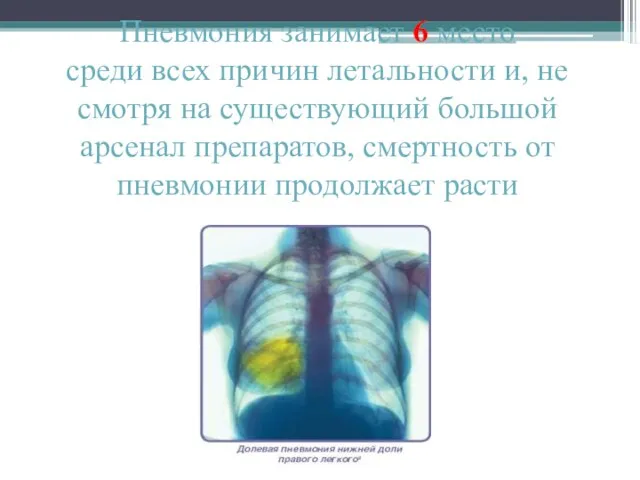 Пневмония занимает 6 место среди всех причин летальности и, не смотря