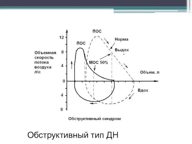 Обструктивный тип ДН