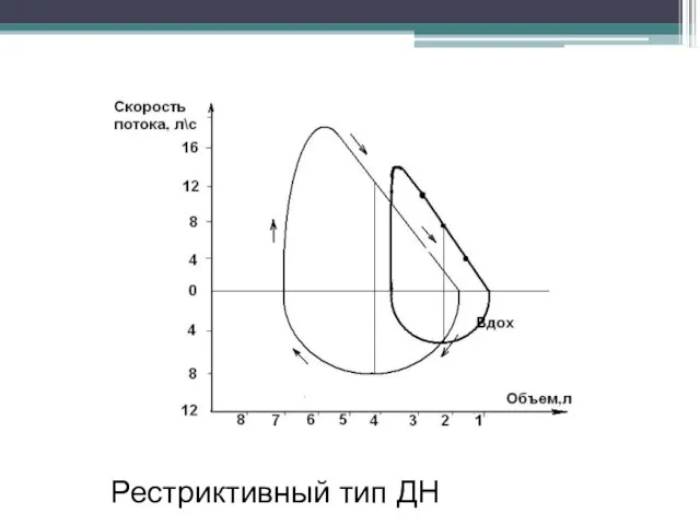 Рестриктивный тип ДН