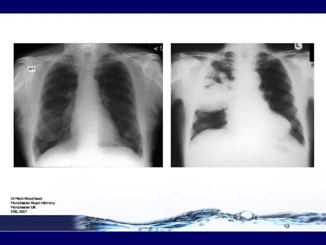 Dr Mark Woodhead Manchester Royal Infirmary Manchester UK ERS, 2007