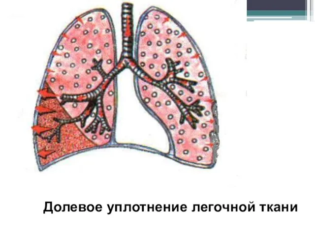 Долевое уплотнение легочной ткани