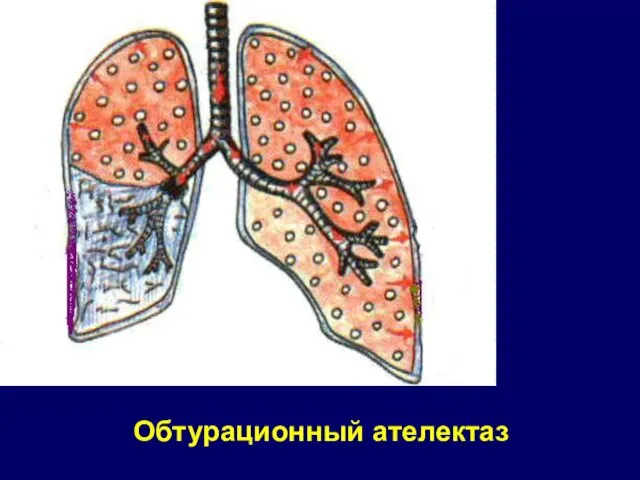 Обтурационный ателектаз