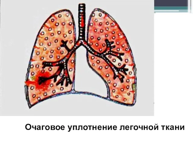 Очаговое уплотнение легочной ткани