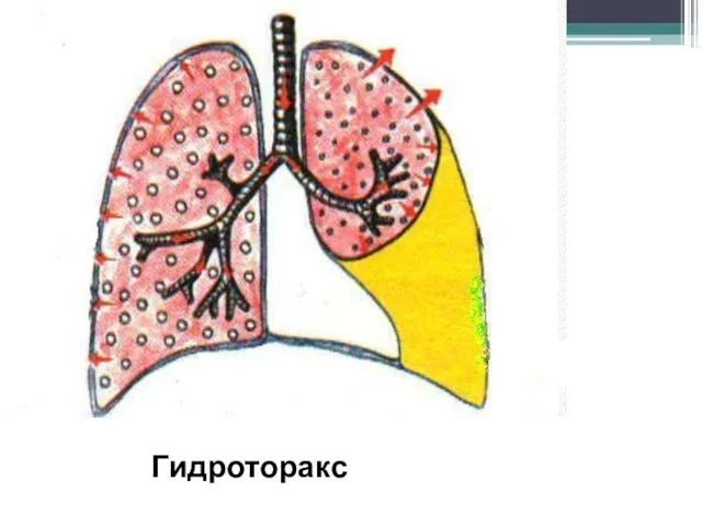 Гидроторакс