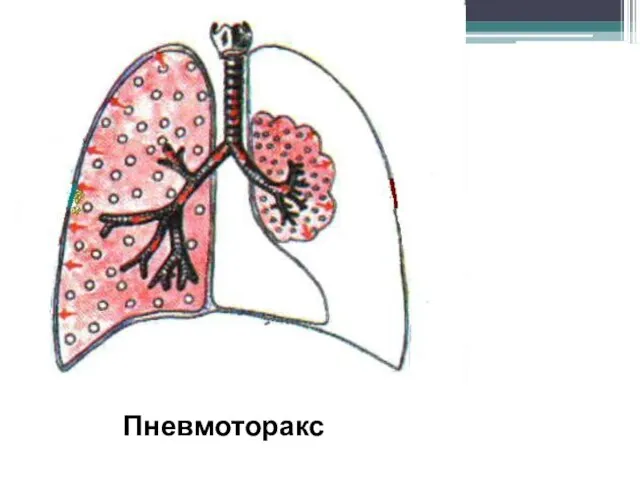 Пневмоторакс