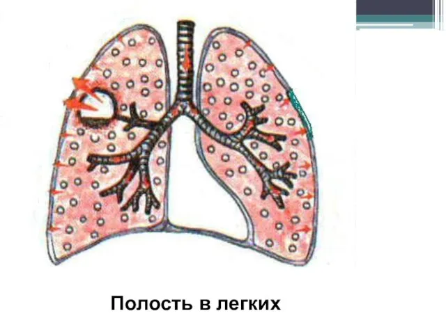 Полость в легких