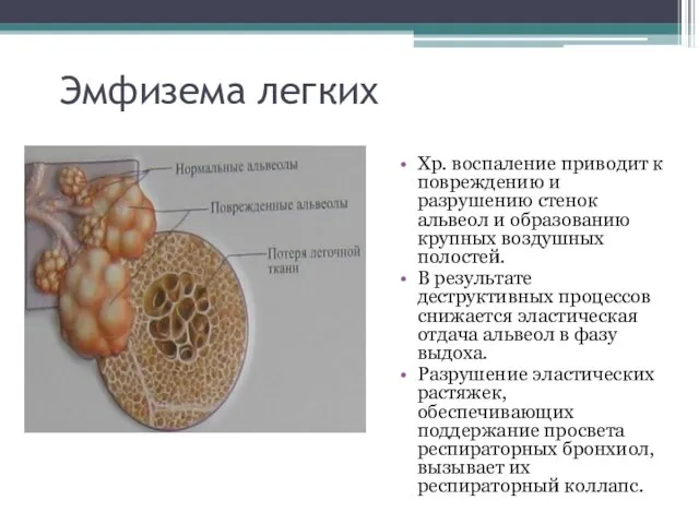 Эмфизема легких Хр. воспаление приводит к повреждению и разрушению стенок альвеол