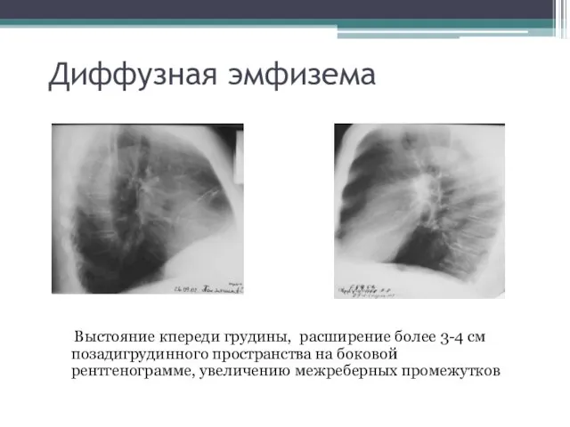 Диффузная эмфизема Выстояние кпереди грудины, расширение более 3-4 см позадигрудинного пространства