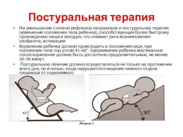 Постуральная терапия На уменьшение степени рефлюкса направлена и постуральная терапия (изменение