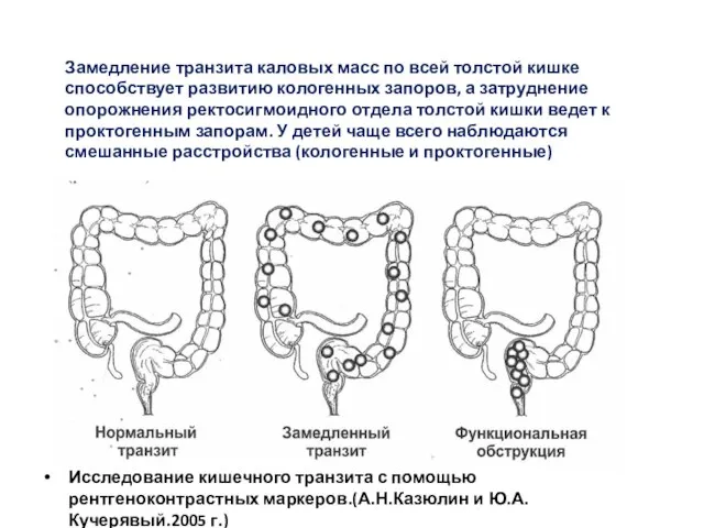 Исследование кишечного транзита с помощью рентгеноконтрастных маркеров.(А.Н.Казюлин и Ю.А.Кучерявый.2005 г.) Замедление