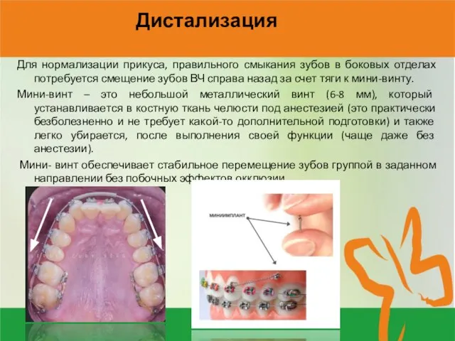 Дистализация Для нормализации прикуса, правильного смыкания зубов в боковых отделах потребуется