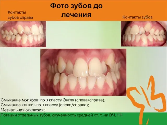 Фото зубов до лечения Смыкание моляров по 3 классу Энгля (слева/справа);