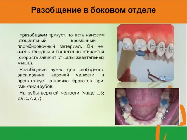 Разобщение в боковом отделе «разобщаем прикус», то есть наносим специальный временный