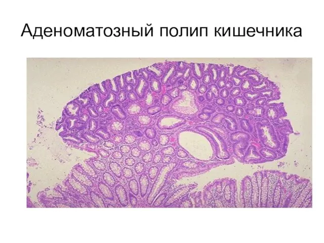 Аденоматозный полип кишечника