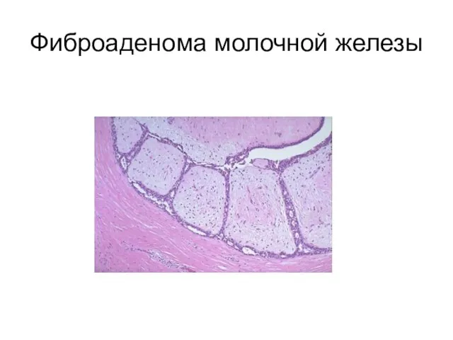 Фиброаденома молочной железы