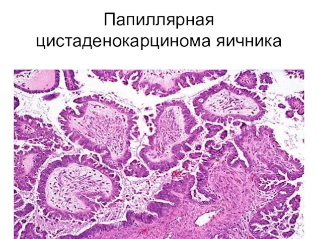 Папиллярная цистаденокарцинома яичника