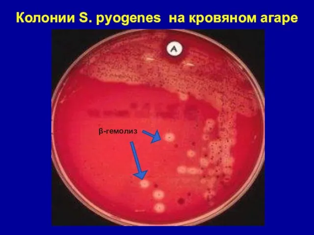 Колонии S. pyogenes на кровяном агаре β-гемолиз