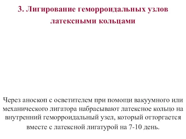 3. Лигирование геморроидальных узлов латексными кольцами Через аноскоп с осветителем при