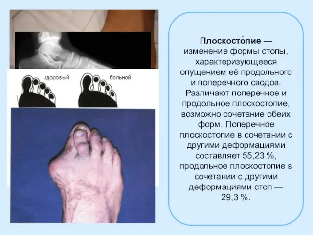 Плоскосто́пие — изменение формы стопы, характеризующееся опущением её продольного и поперечного