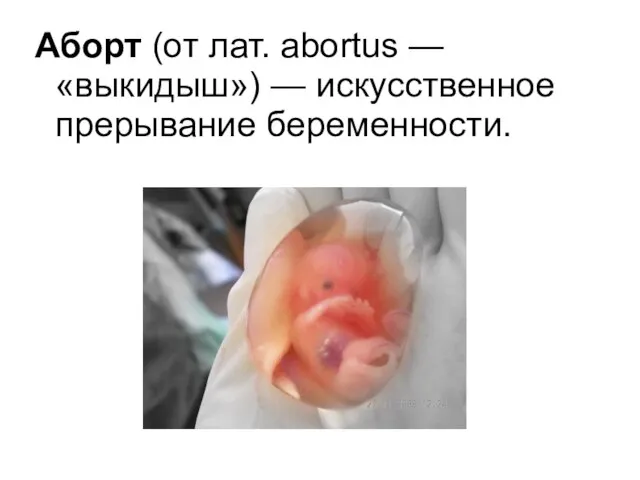 Аборт (от лат. abortus — «выкидыш») — искусственное прерывание беременности.