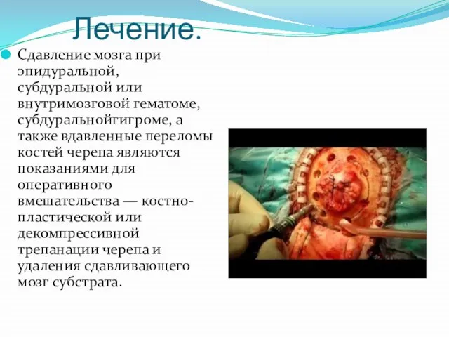 Лечение. Сдавление мозга при эпидуральной, субдуральной или внутримозговой гематоме, субдуральнойгигроме, а