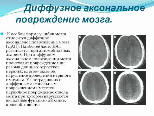 Диффузное аксональное повреждение мозга. К особой форме ушибов мозга относится диффузное