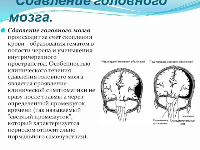 Сдавление головного мозга. Сдавление головного мозга происходит за счет скопления крови