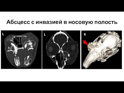 Абсцесс с инвазией в носовую полость